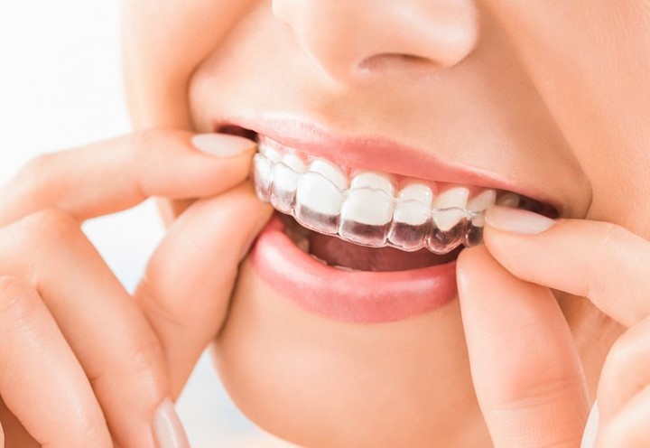 telsiz-ortodonti-invisalign-1
