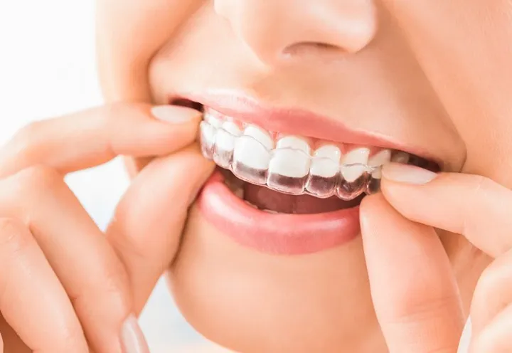 telsiz-ortodonti-invisalign-1