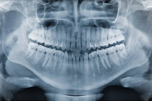 Röntgenbild av tänderna