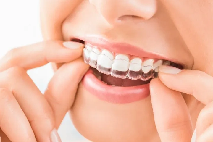 Tjej sätter in tandställning